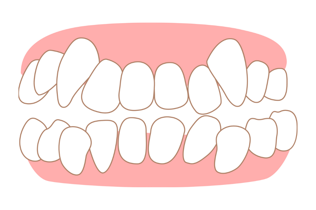 インビザラインで八重歯を治療する4つの方法
