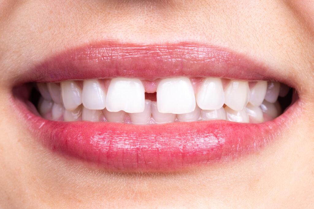 すきっ歯（空隙歯列）はインビザラインで治療できる？矯正方法や治療するメリット