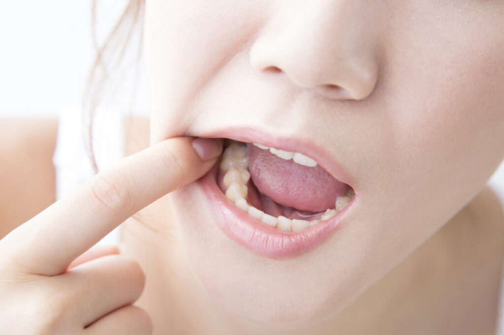 インビザライン治療中、口内炎はできやすくなるのか。考えられる原因や対処法