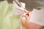 インビザラインで治療では歯を削ることがある！ディスキング（IPR）の目的とメリット・デメリット